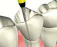 Root Canal Procedure