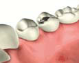 Root Canal Treatment